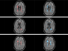 Multiple Sclerosis