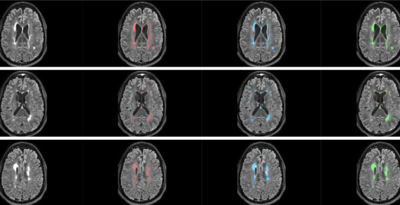 Multiple Sclerosis